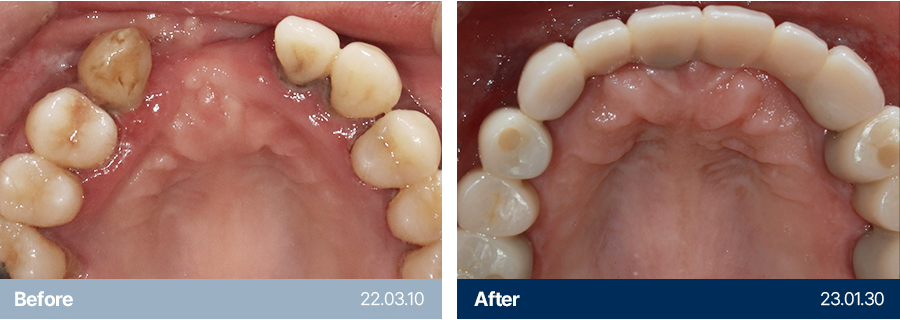 임플란트 사례1