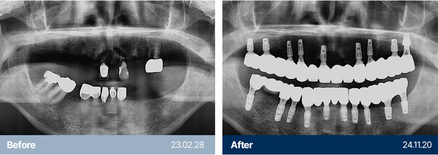 임플란트 사례10