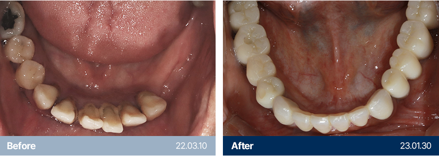 임플란트 사례2