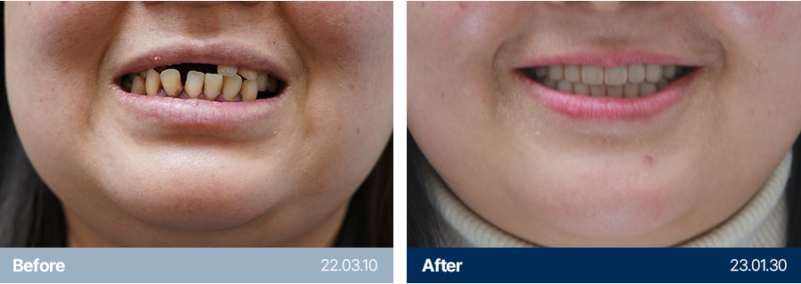 임플란트 사례3