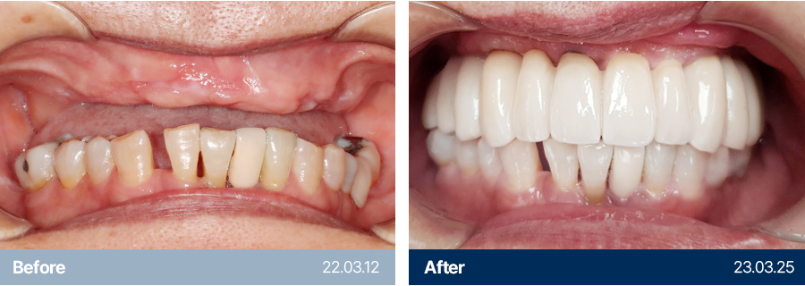 임플란트 사례4