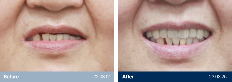 임플란트 사례5