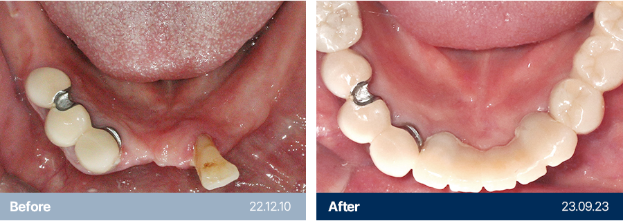 임플란트 사례6