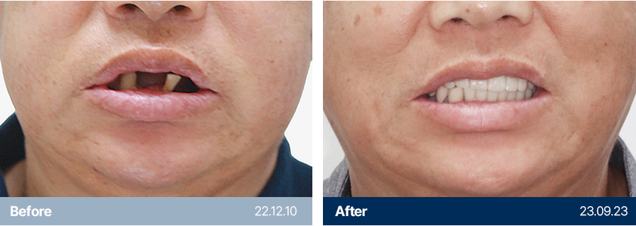 임플란트 사례7