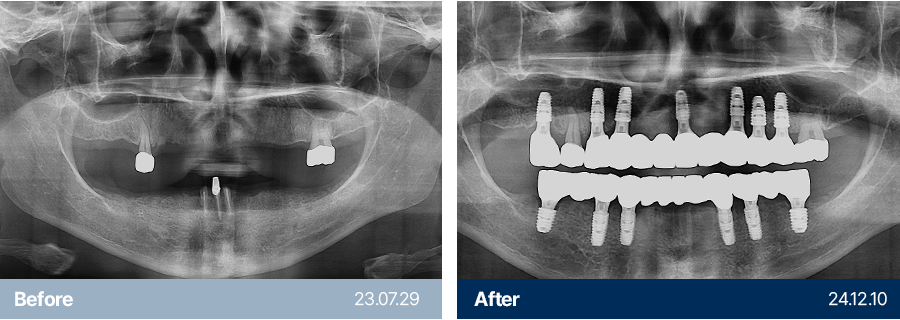 임플란트 사례8