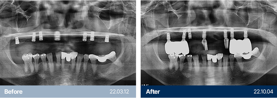 임플란트 사례9