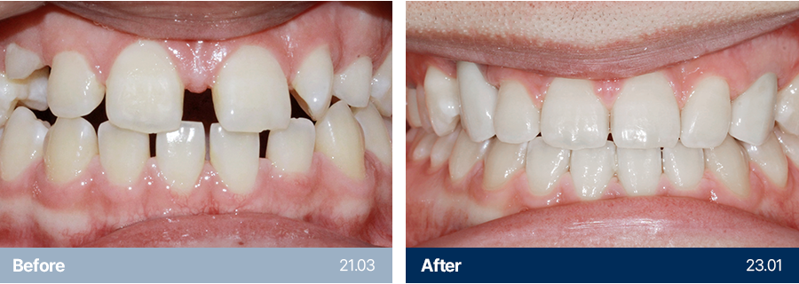 치아교정 사례1