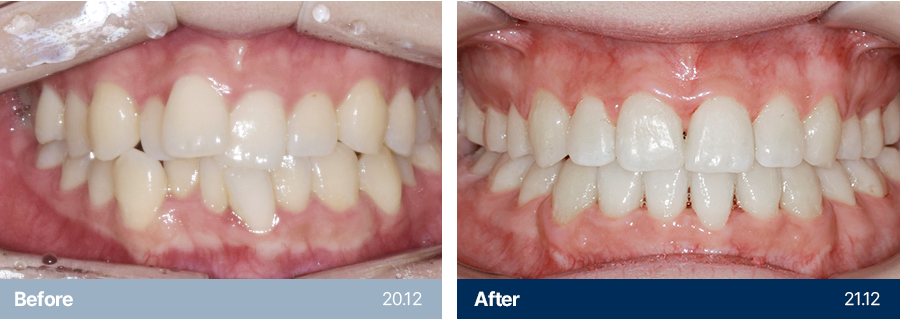 치아교정 사례1