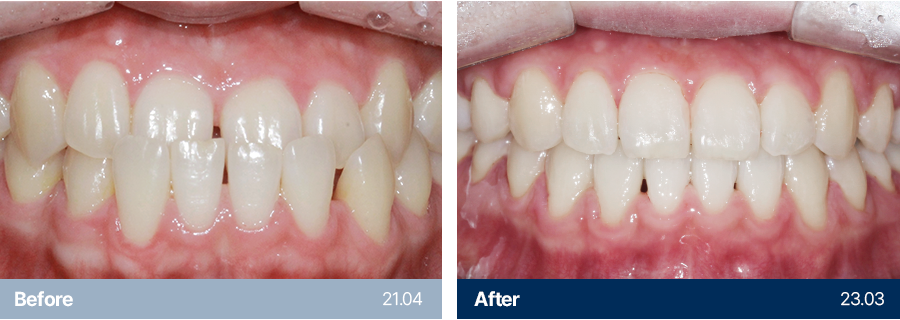 치아교정 사례1
