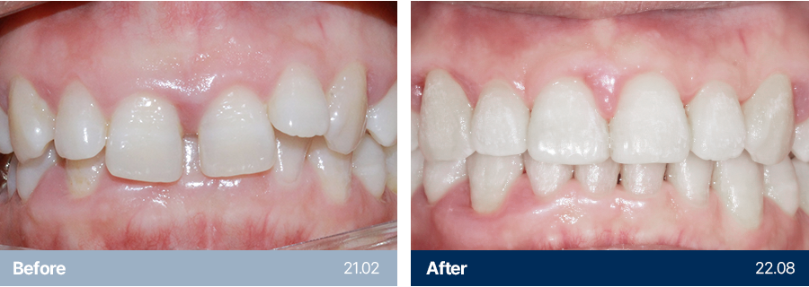 치아교정 사례1