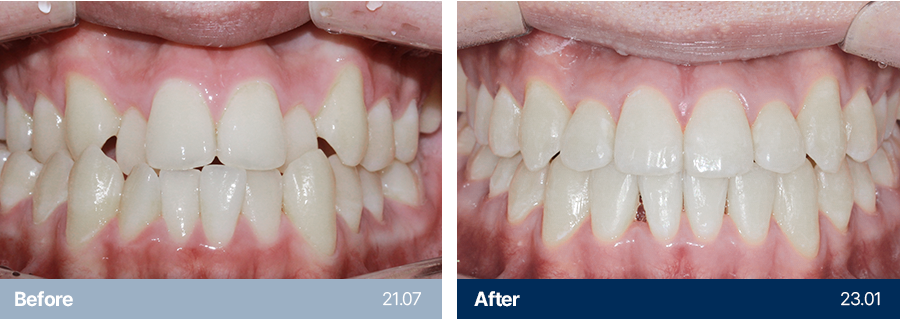 치아교정 사례1