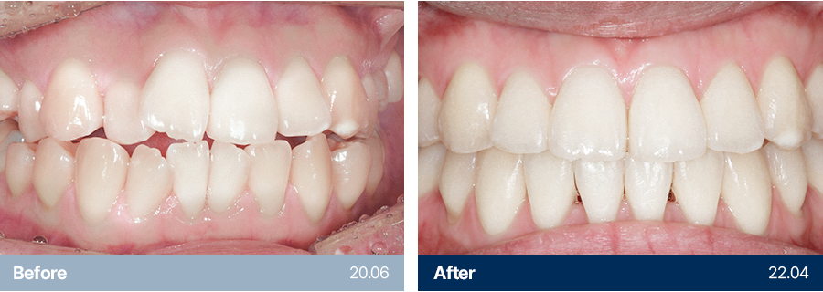 치아교정 사례1