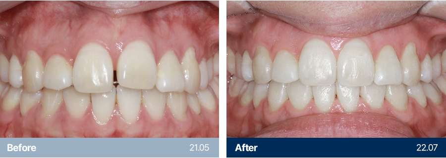 치아교정 사례1
