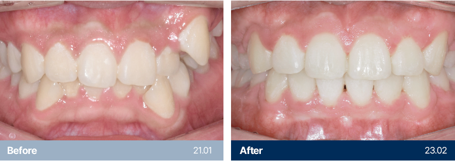 치아교정 사례1