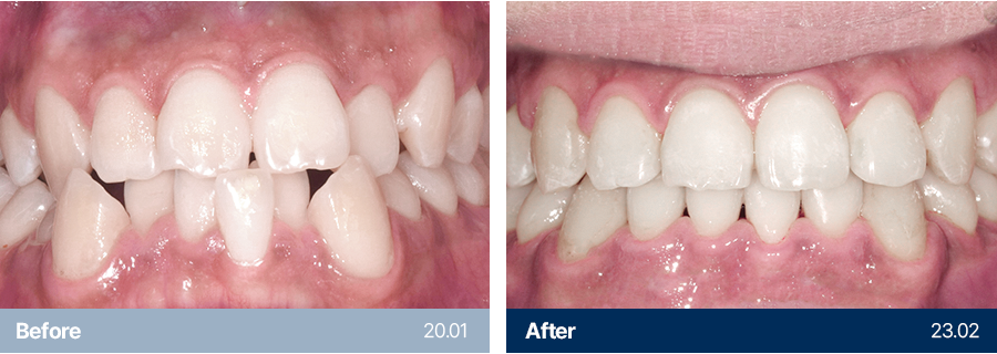 치아교정 사례1